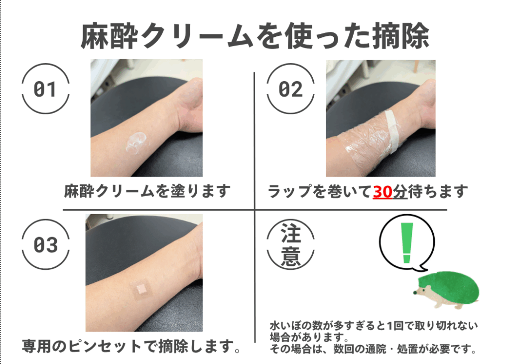 麻酔クリームを使った摘除の手順。麻酔クリームを塗る、ラップを巻いて30分待つ、専用のピンセットで摘除する