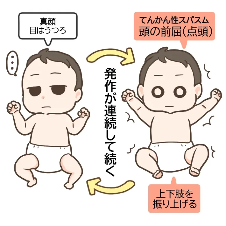 てんかん性スパズムの図。真顔で目はうつろな状態から、頭を前に倒し(点頭)、両手足を振り上げる動きが連続して続く