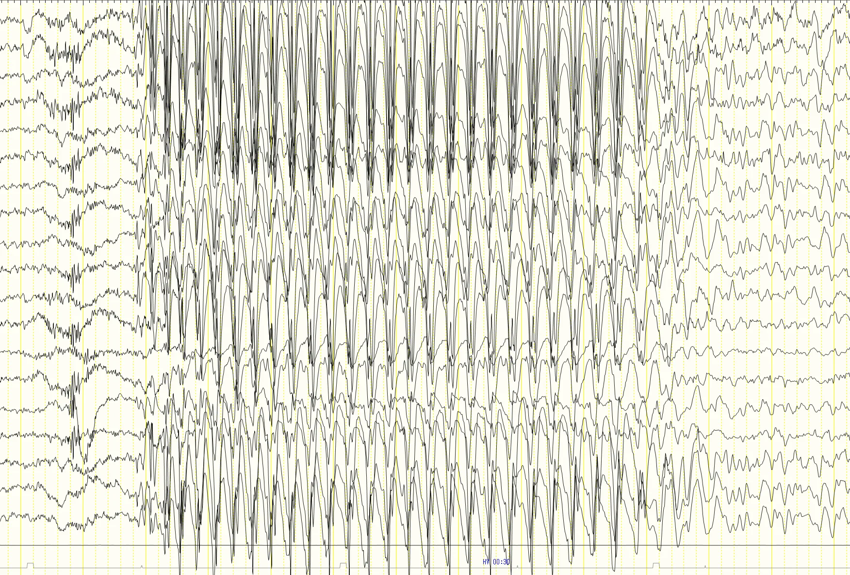 小児欠神てんかんに特徴的な3Hz棘徐波複合の脳波パターン