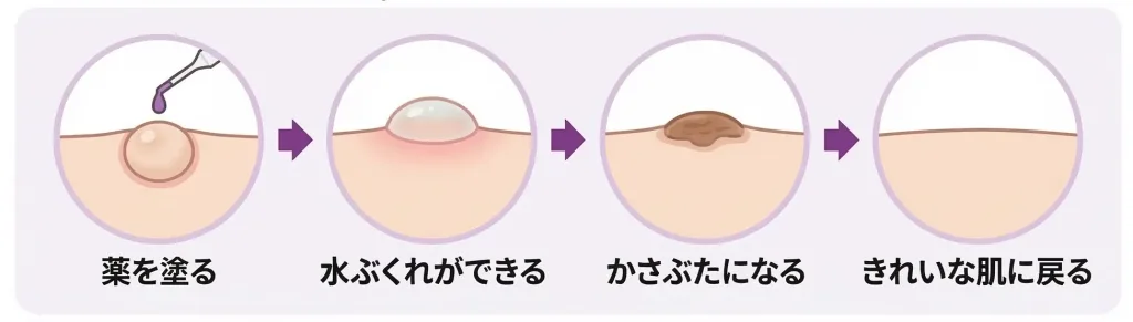 ワイキャンス治療の仕組み。薬を塗る、水ぶくれができる、かさぶたになる、きれいになる