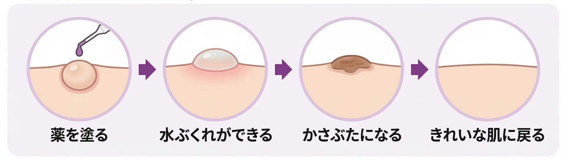 ワイキャンス治療の仕組み - 薬を塗る→水ぶくれができる→かさぶたになる→きれいな肌に戻る