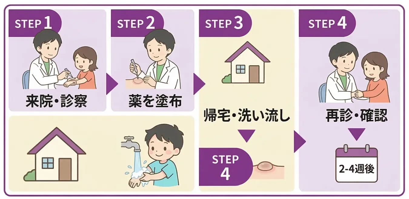 ワイキャンス治療の流れ - STEP1来院・診察→STEP2薬を塗布→STEP3帰宅・洗い流し→STEP4再診・確認