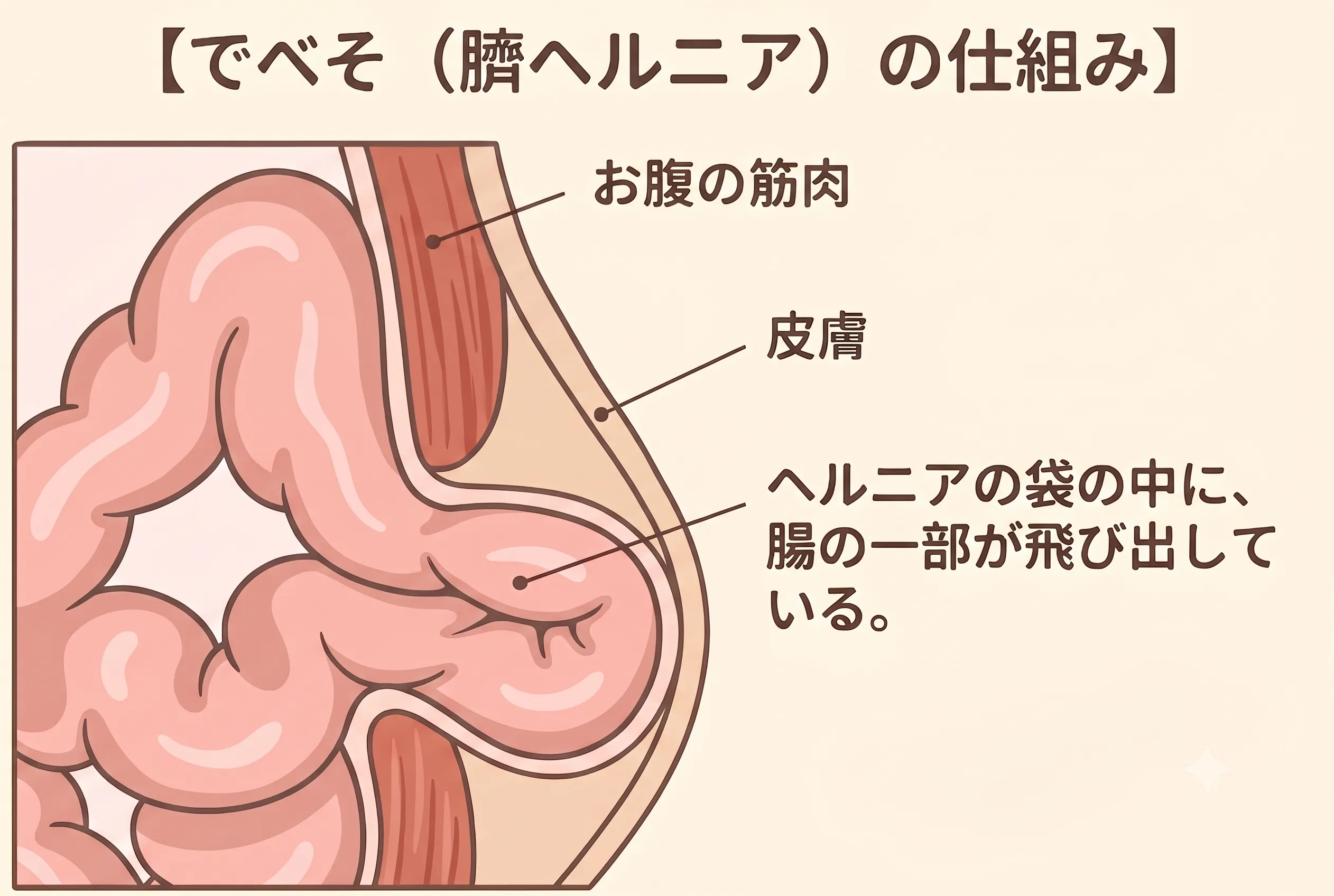 臍ヘルニアの仕組みを示す断面イラスト